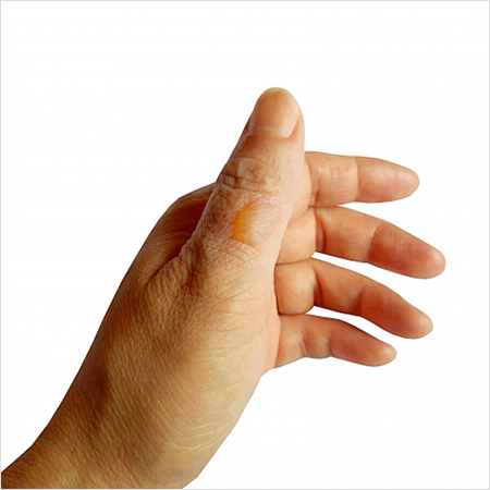 剥ける 皮 指先 の 手湿疹の治し方…症例写真・症状・原因・治療法 [皮膚・爪・髪の病気]